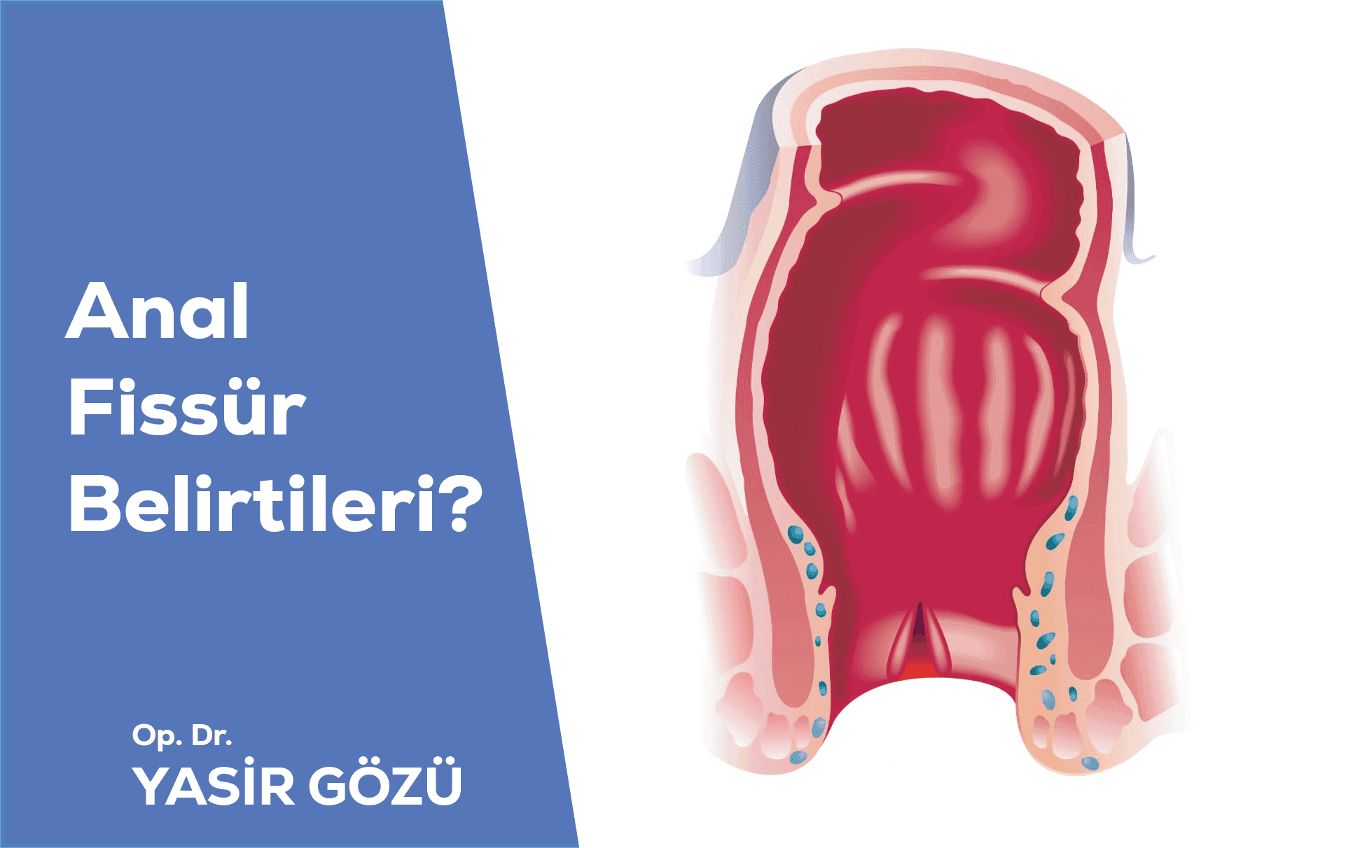anal fissür belirtileri