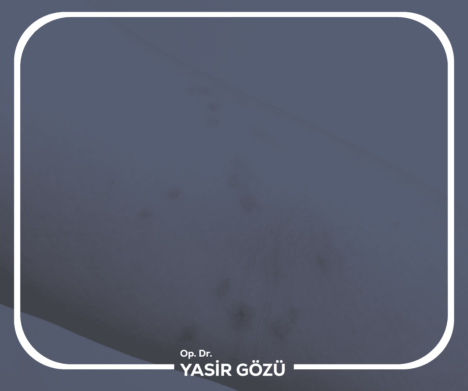 ما هو التهاب الغدد العرقية القيحي؟