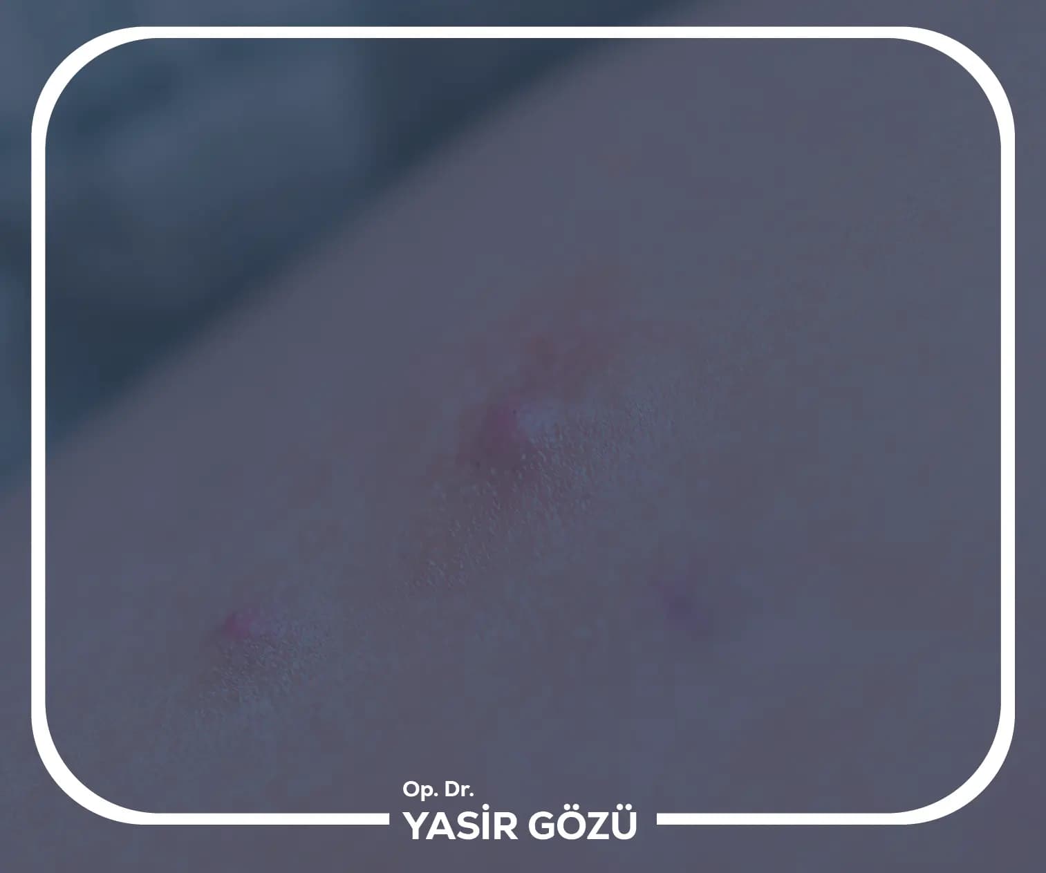 أعراض التهاب الغدد العرقية القيحي؟