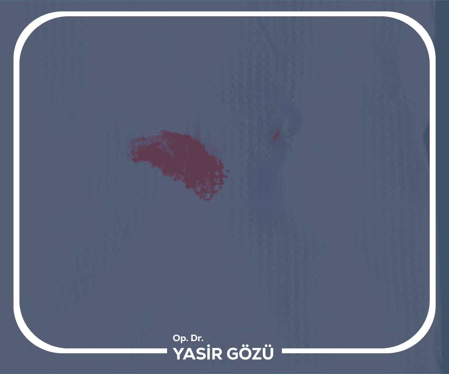 ما هو النزيف الشرجي؟