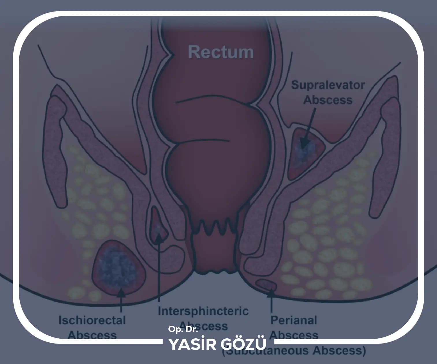 أعراض خراج الشرج