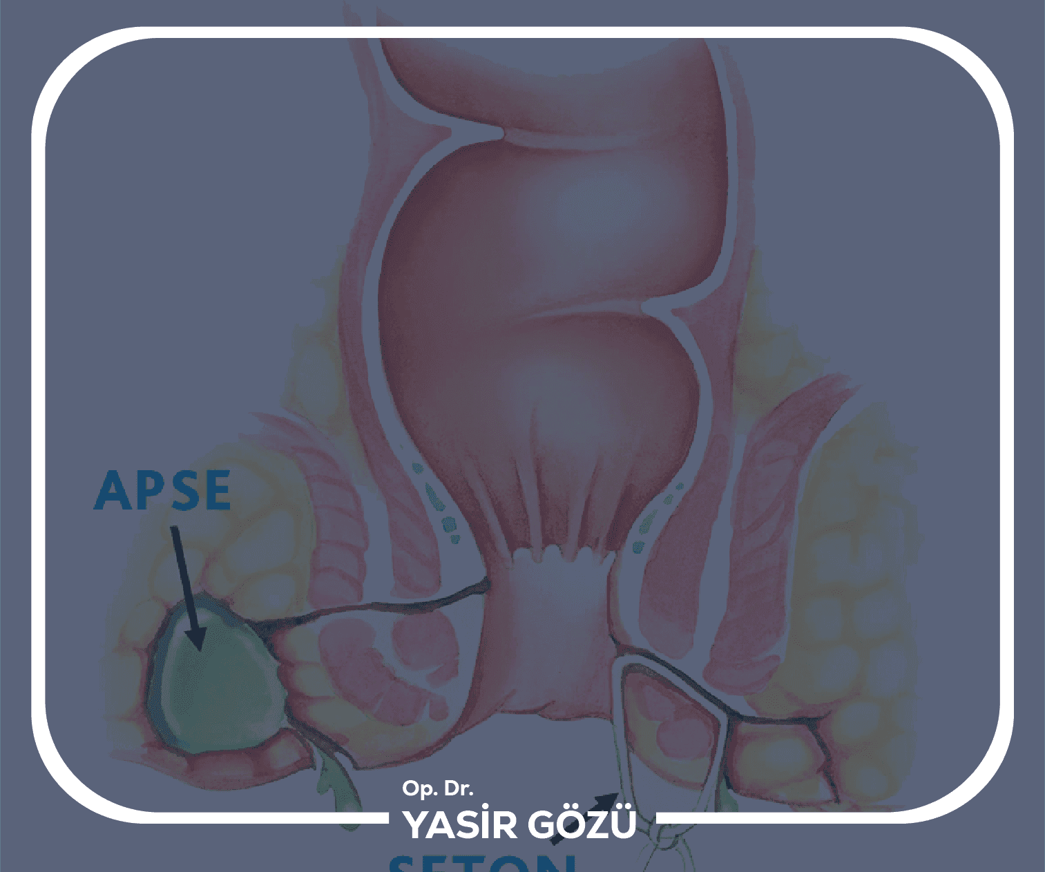 علاج الناسور الشرجي بالليزر؟