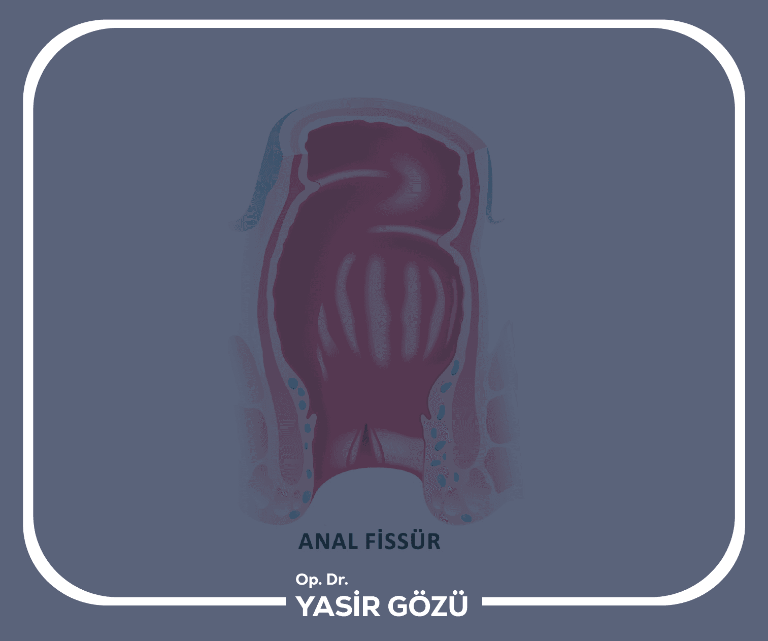 علاج الشق الشرجي بالليزر