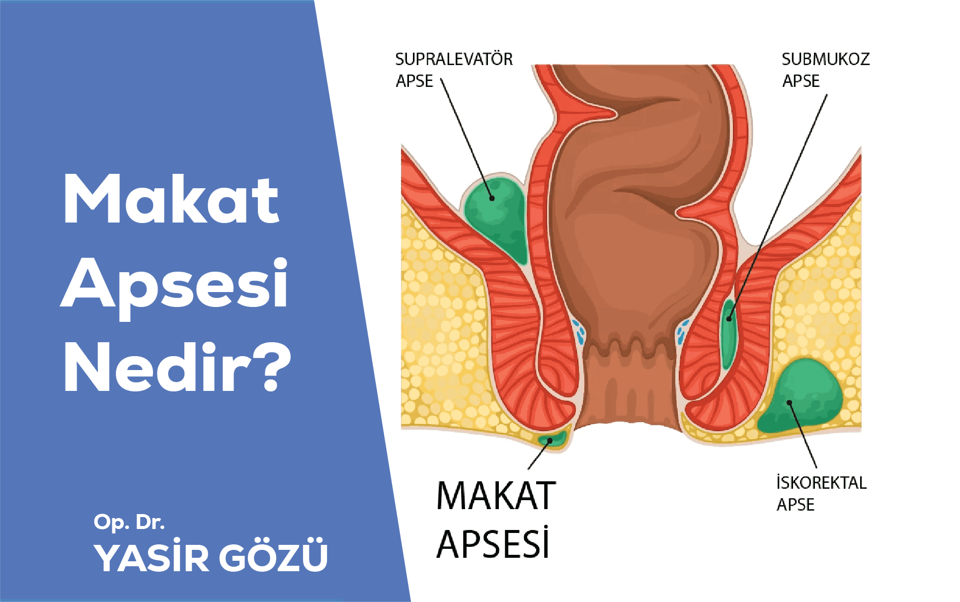 makat apsesi nedir