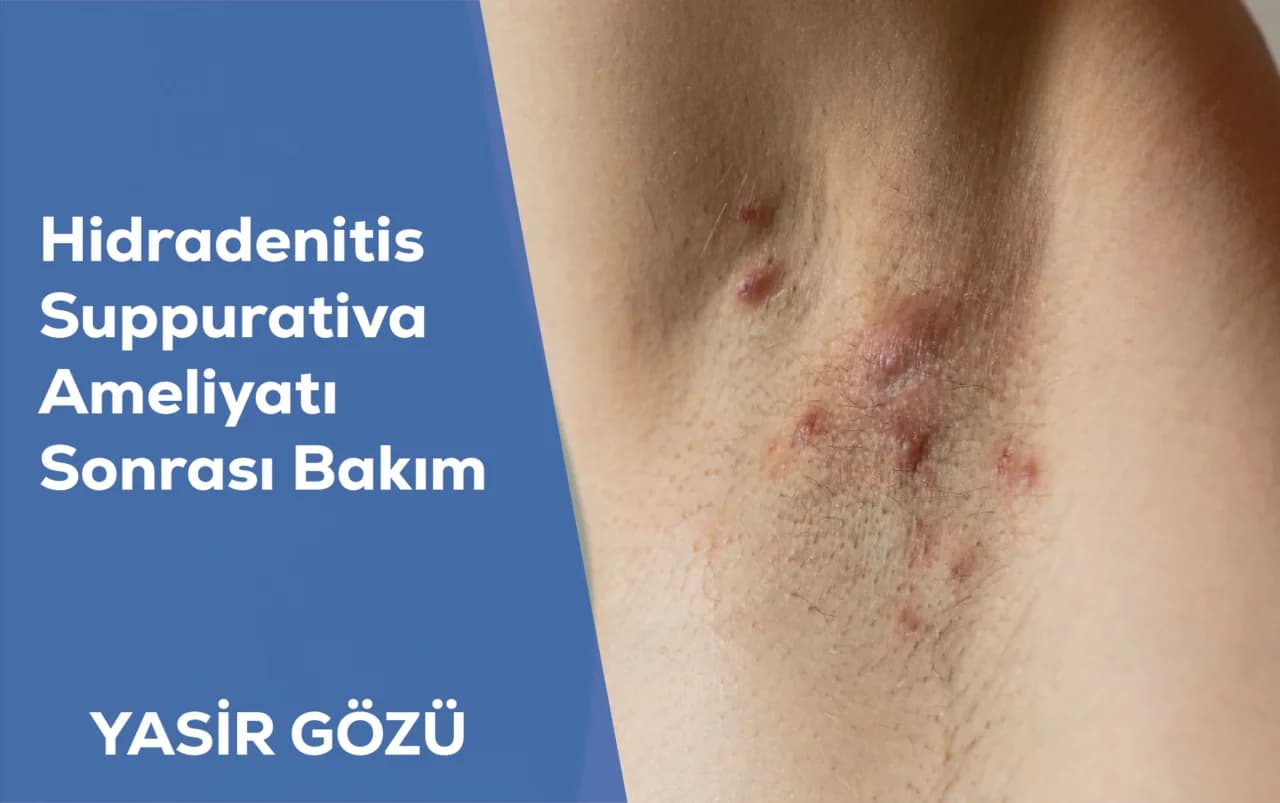 Hidradenitis Suppurativa Ameliyatı Sonrası Bakım