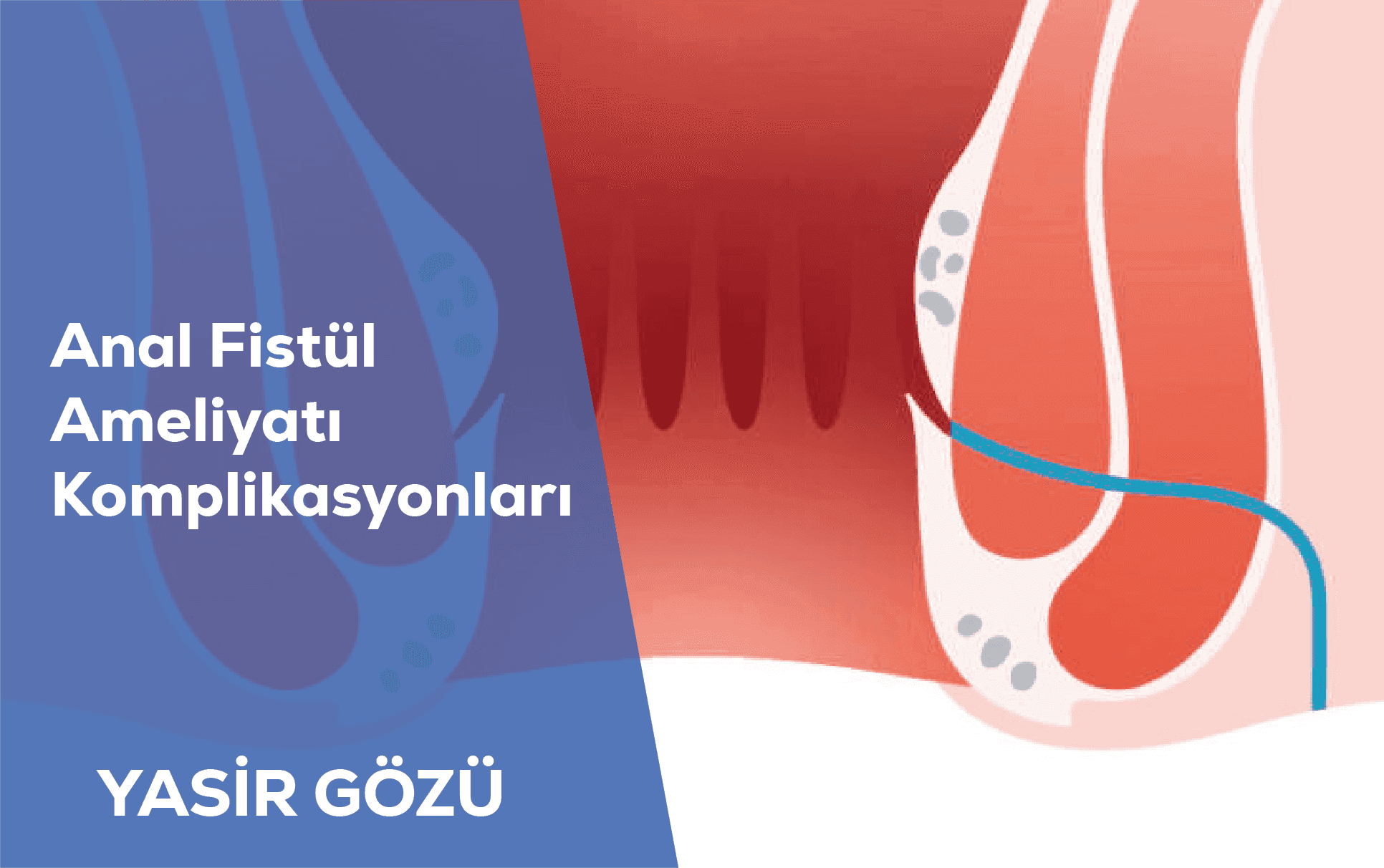 anal fistül komplikasyonları