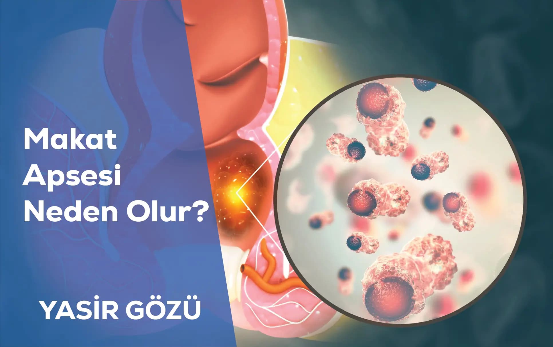 Makat Apsesi Neden Olur?