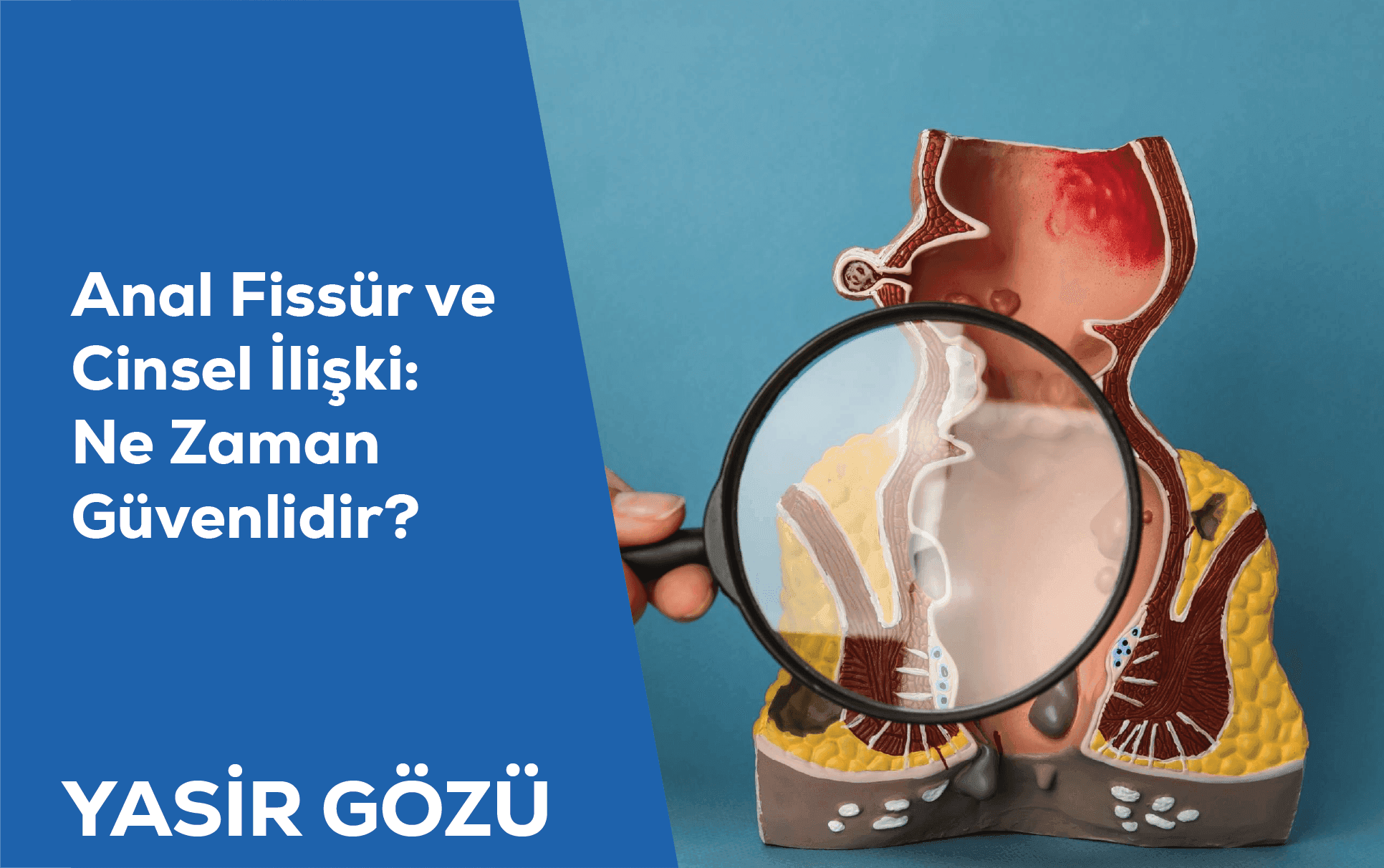 anal fissür ve cinsellik