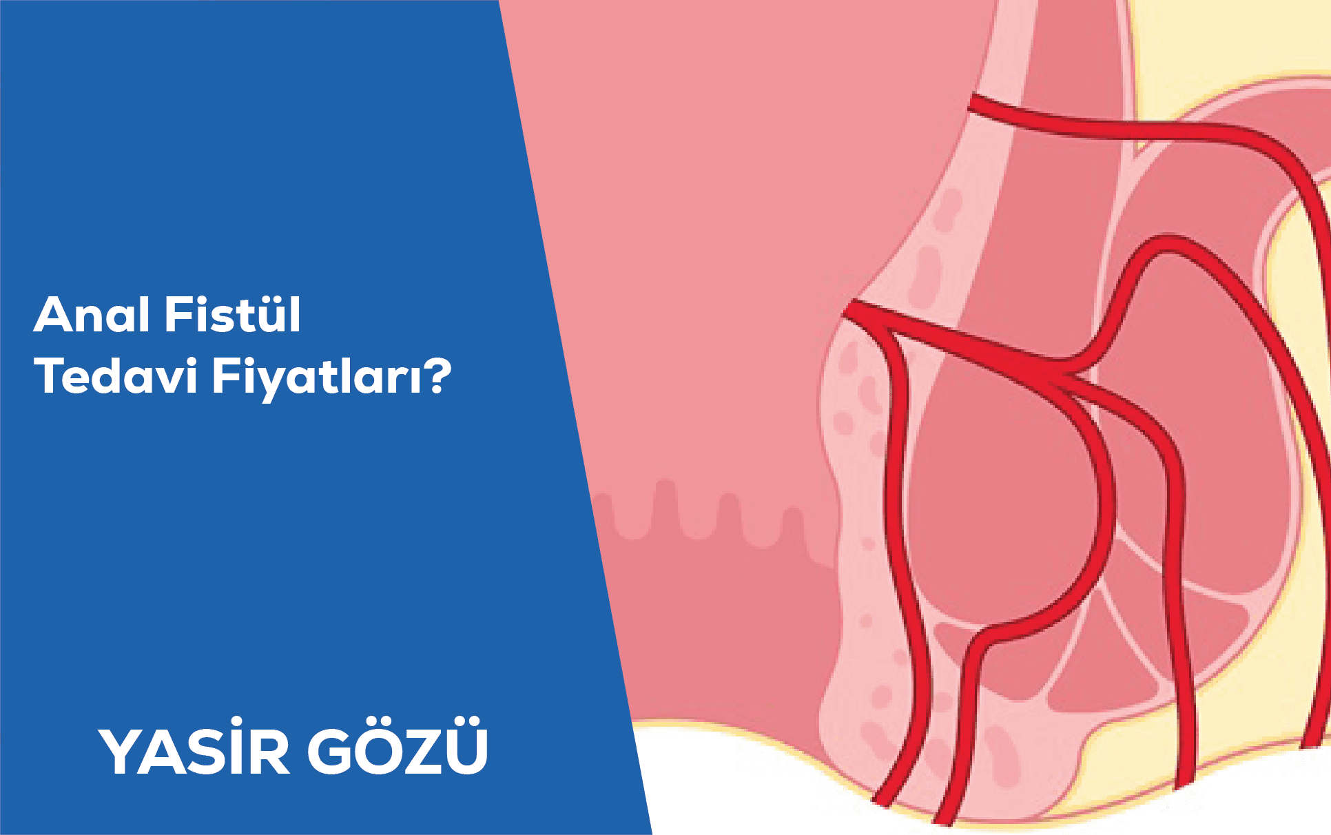 anal fistula surgery cost
