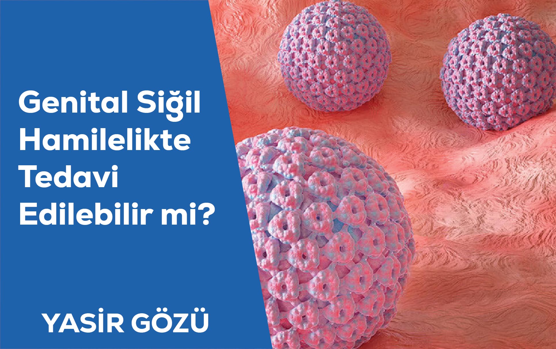 genital siğil hamilelik