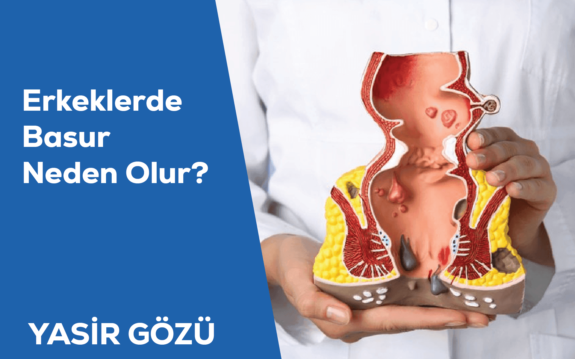 erkeklerde basur