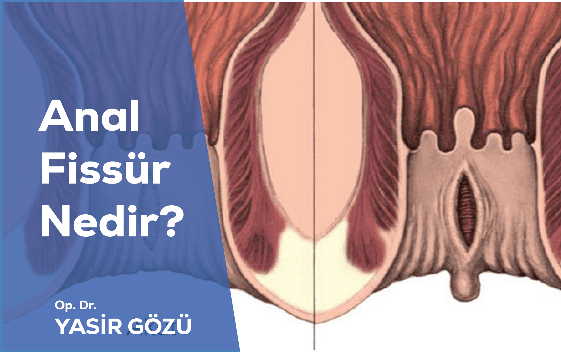 Makat Çatlağı (Anal Fissür) Nedir? Belirtiler, Evde Bakım ve Tedavi Seçenekleri