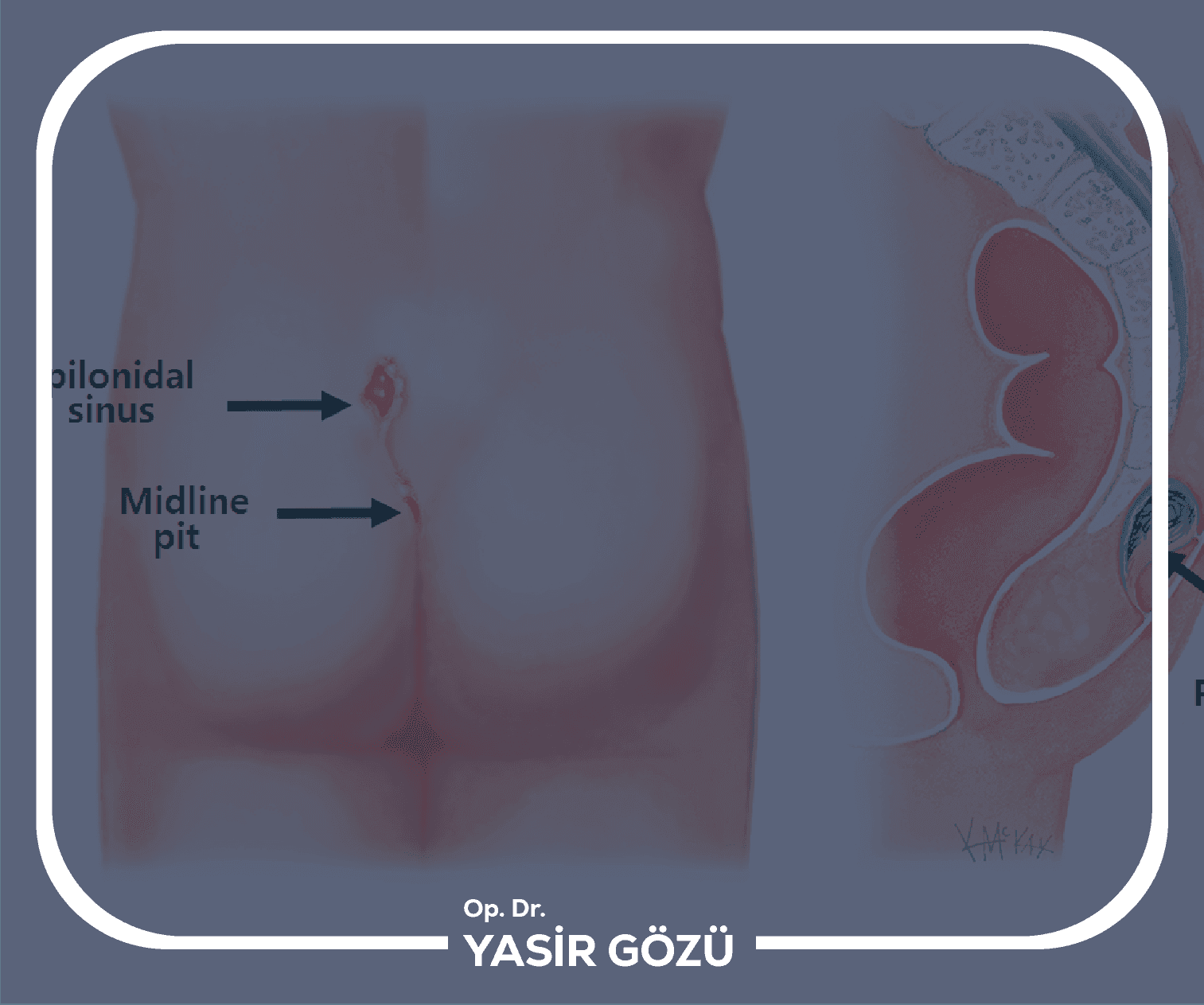 Pilonidal Sinus Symptoms