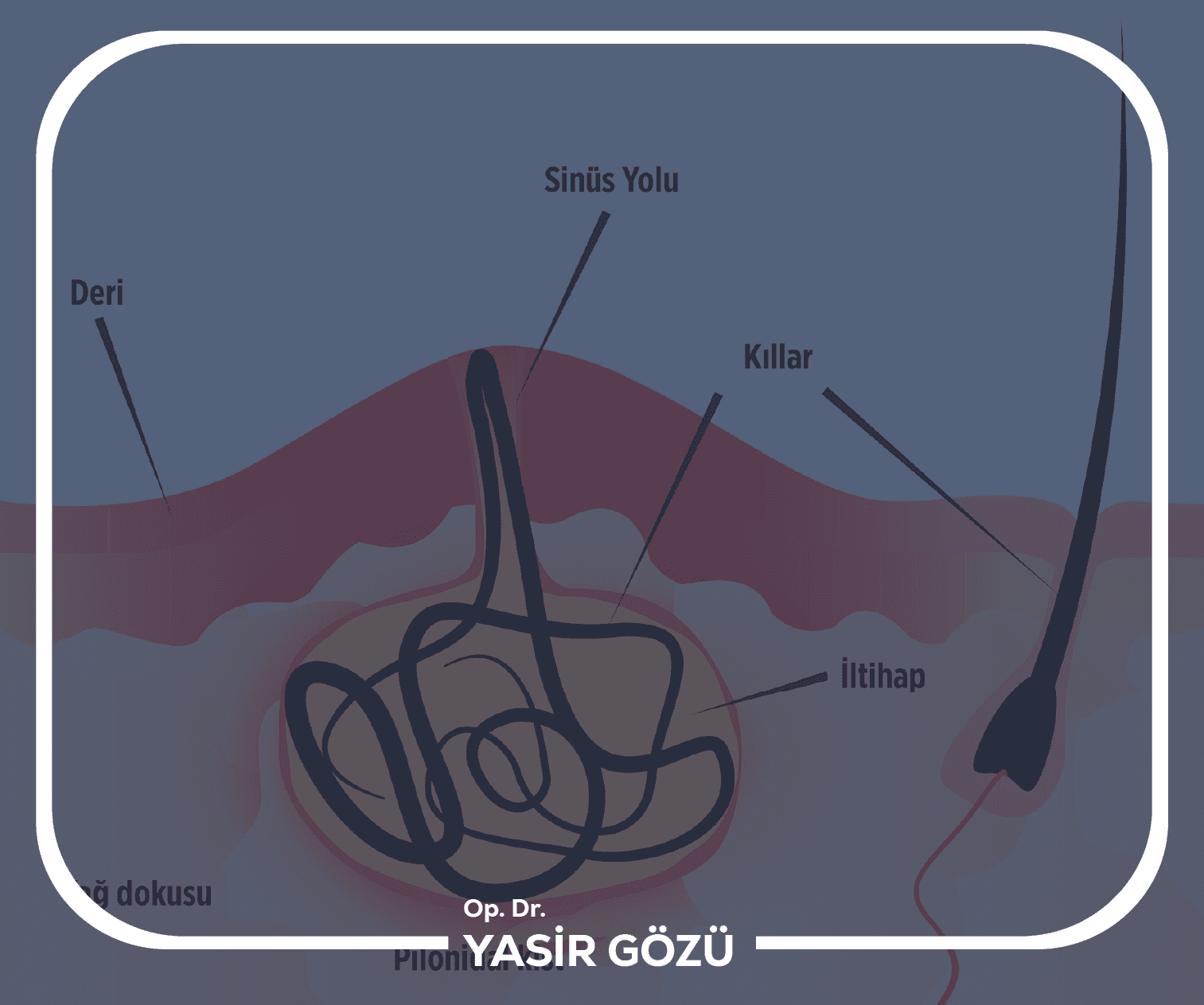 Laser Pilonidal Sinus Treatment