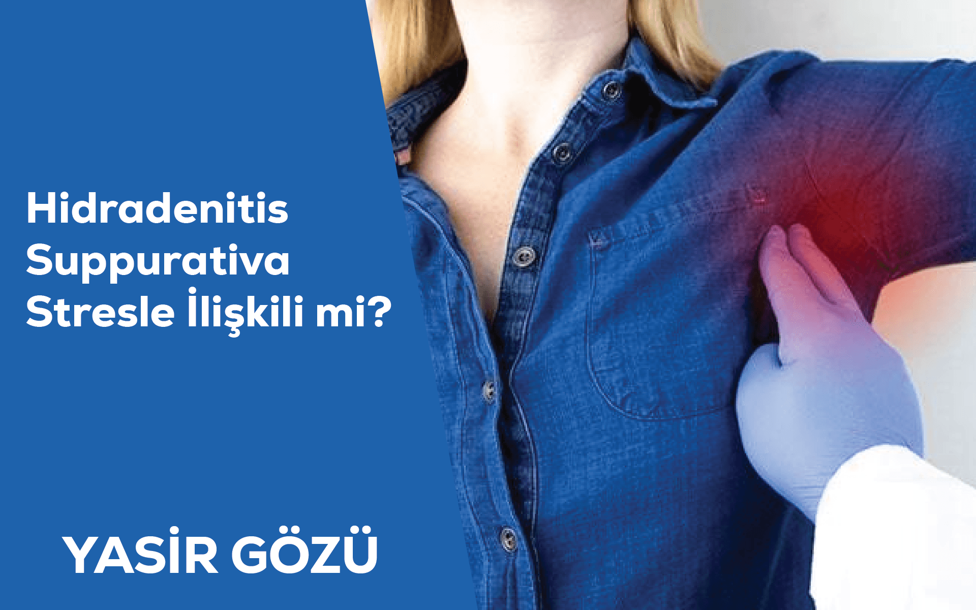Hidradenitis Suppurativa