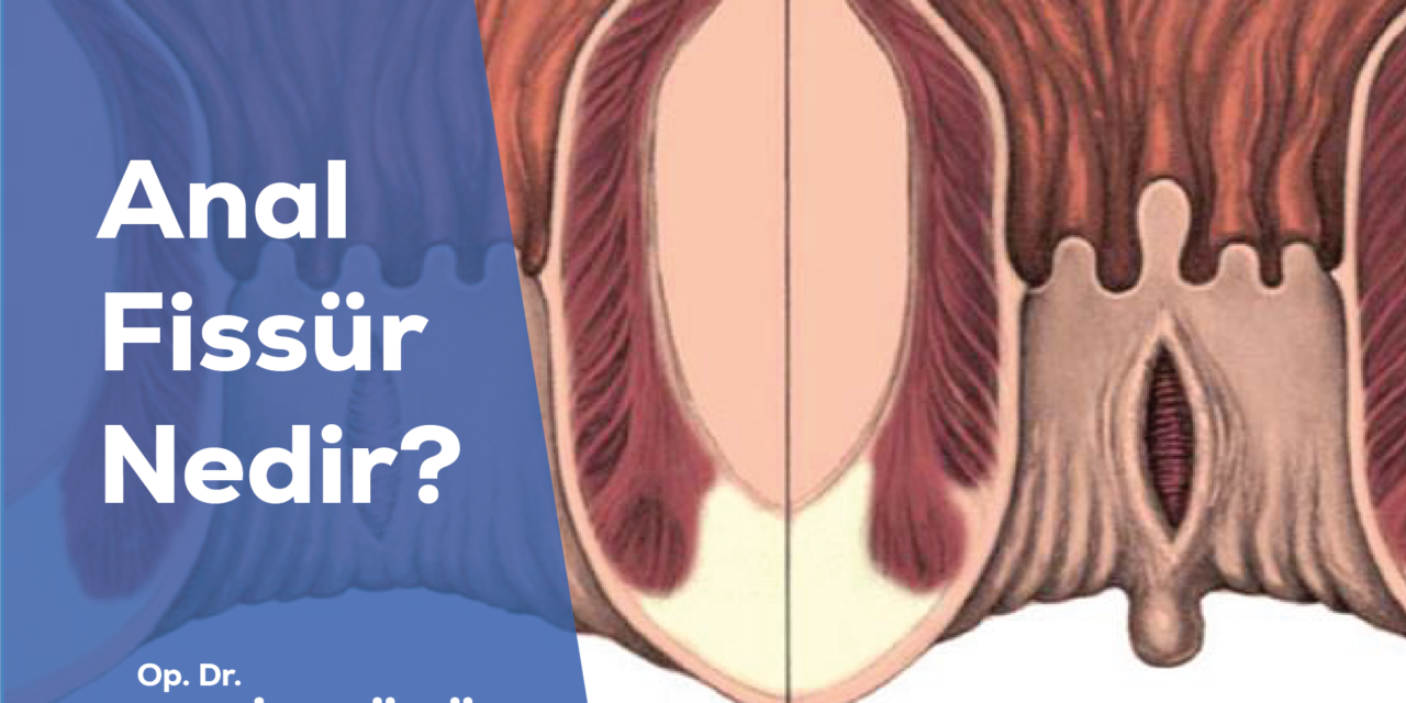 Anal Fissür Nedir?