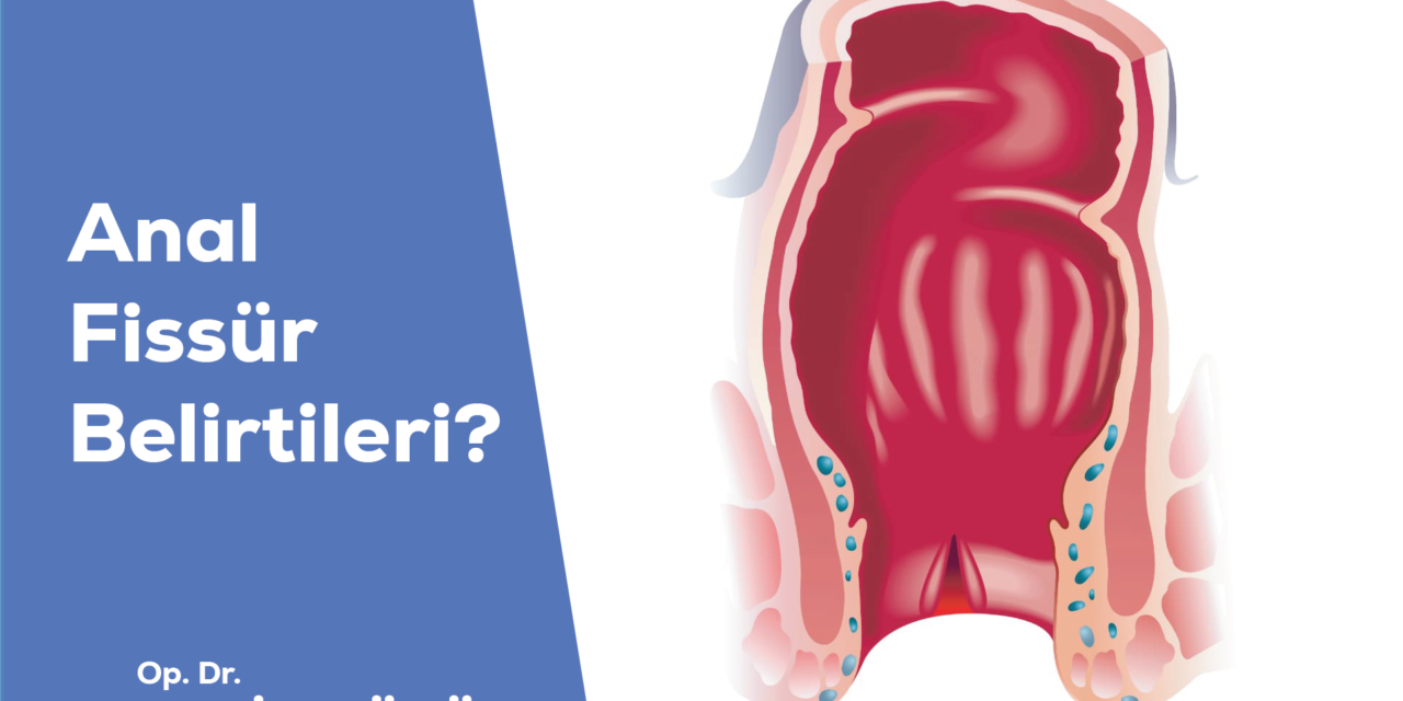 Anal Fissür Belirtileri Nelerdir?