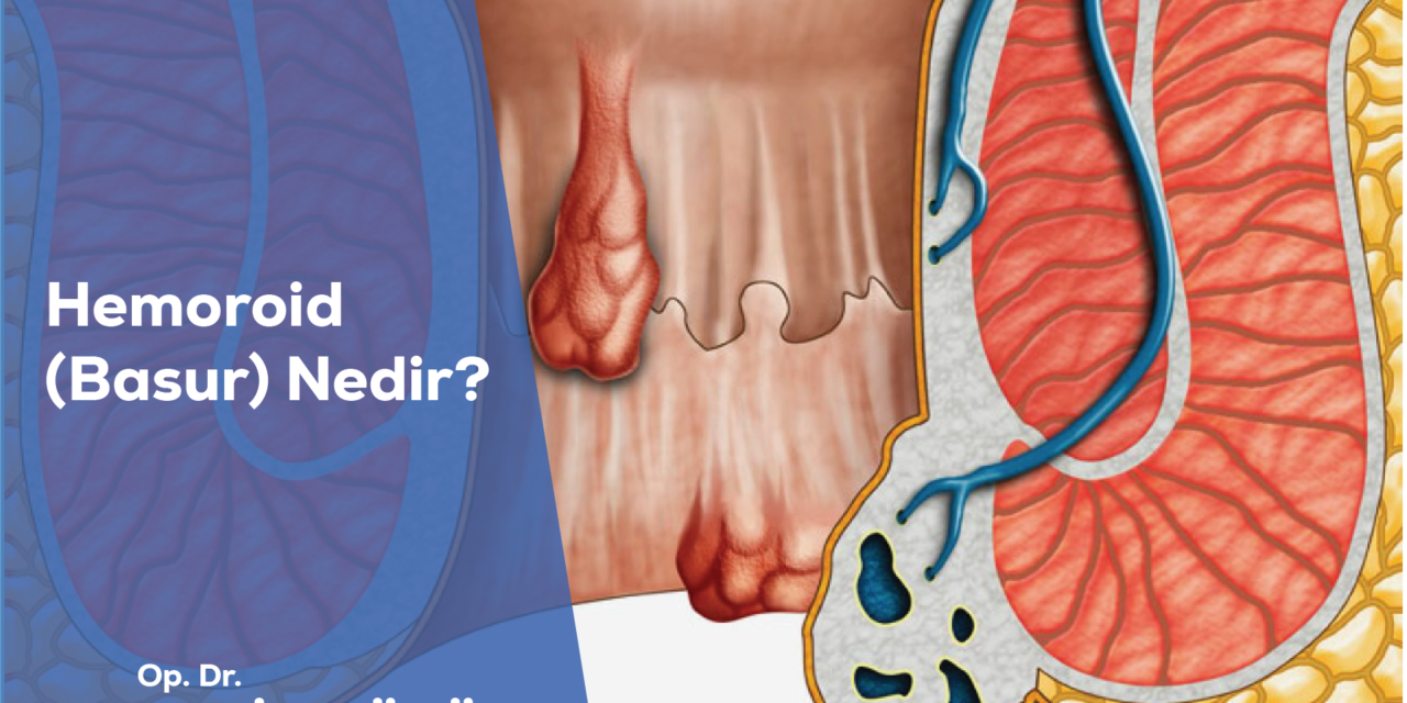 Hemoroid (Basur) Nedir?