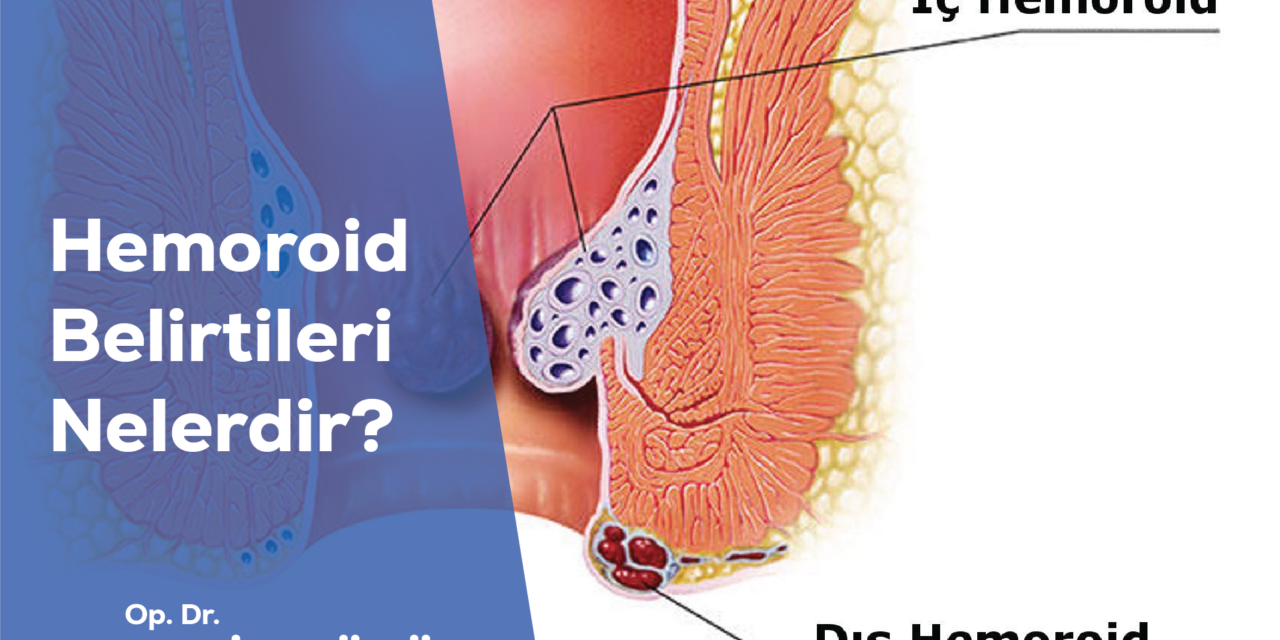 Hemoroid Belirtileri Nelerdir?