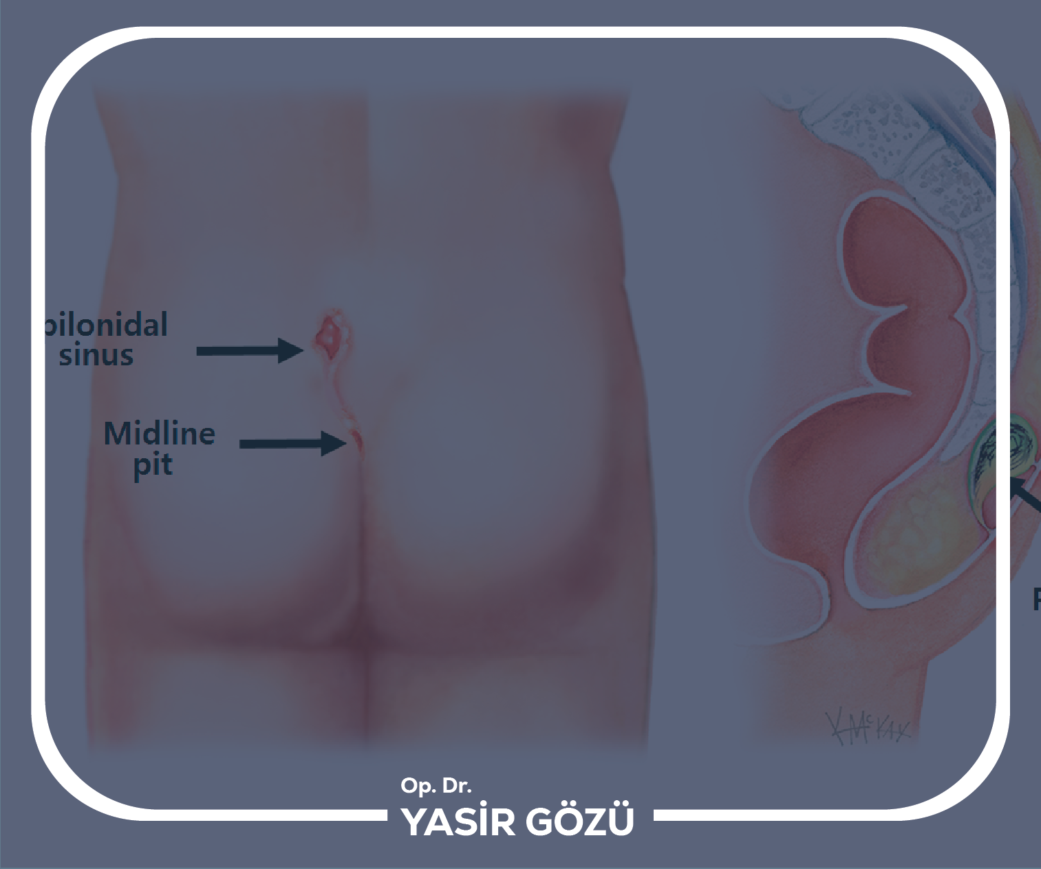 kıl dönmesi