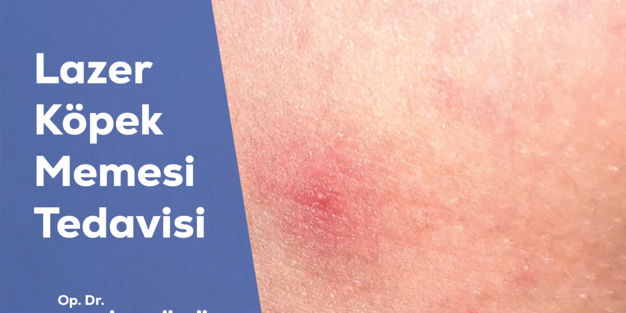 Köpek Memesi Tedavisinde Lazer Yöntemi