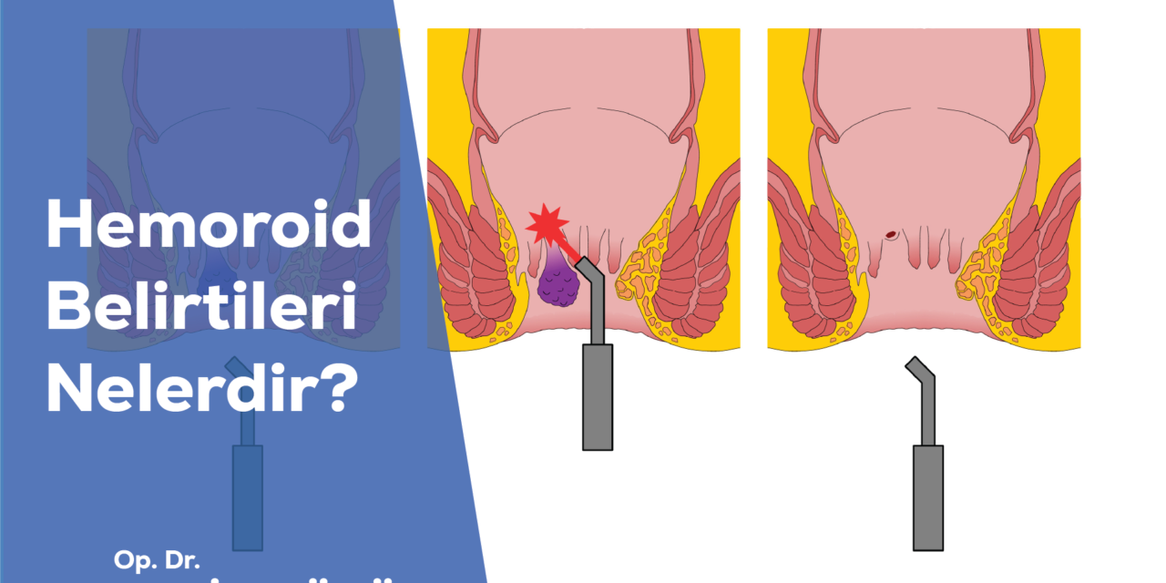 Lazer ile Hemoroid Tedavisi