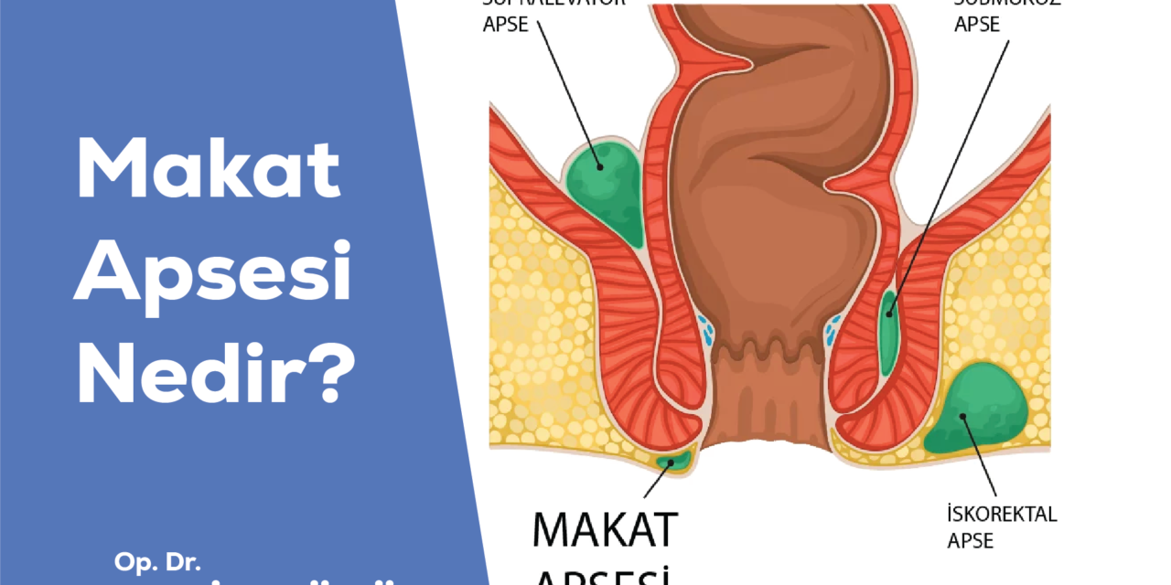 Makat Apsesi Nedir?