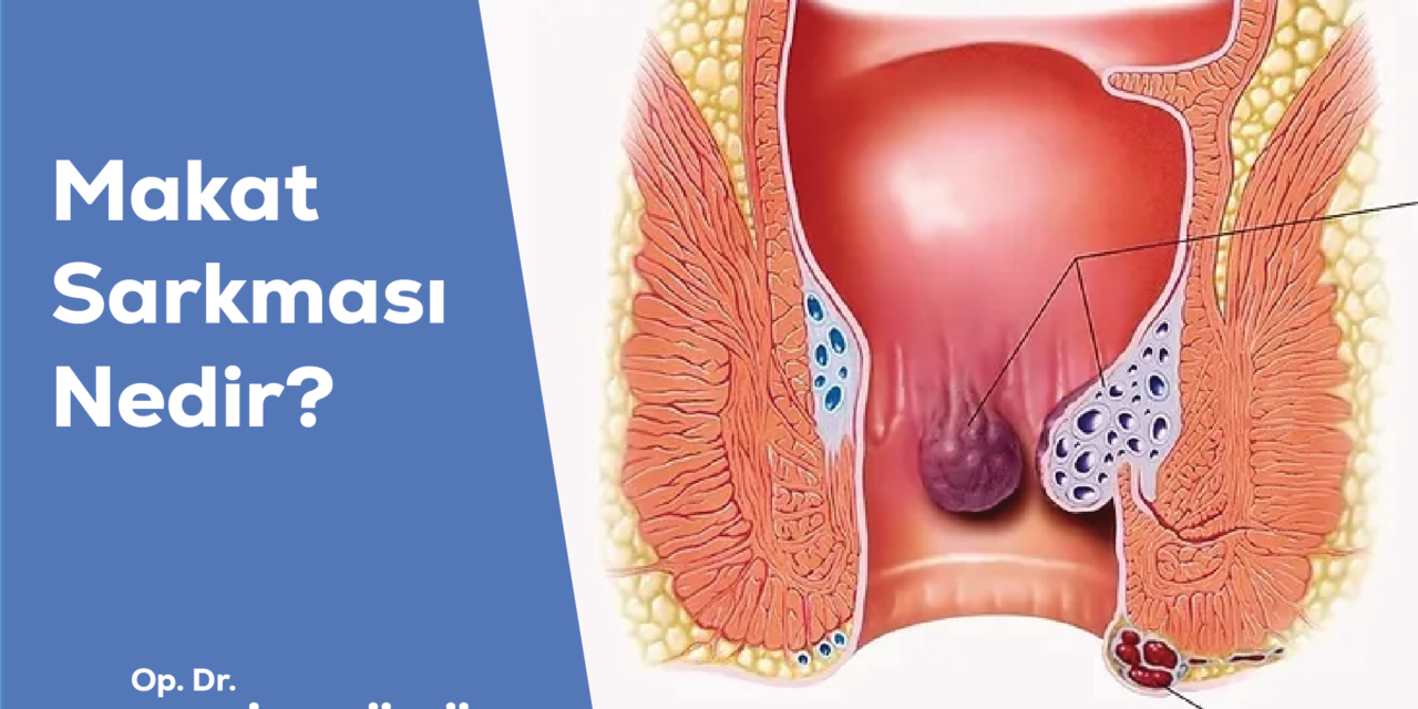 Makat Sarkması Nedir?