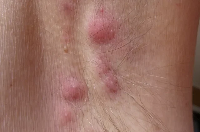 Hidradenitis Suppurativa