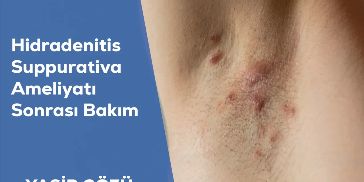 Hidradenitis Suppurativa Ameliyatı Sonrası Bakım