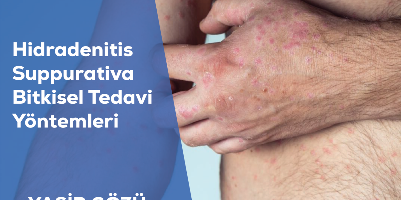 Hidradenitis Suppurativa Bitkisel Tedavi Yöntemleri