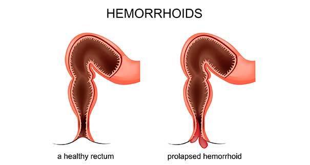 hemoroid