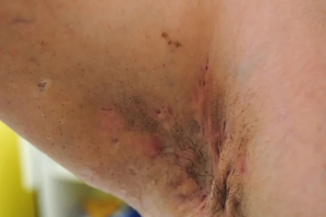 hidradenitis suppurativa