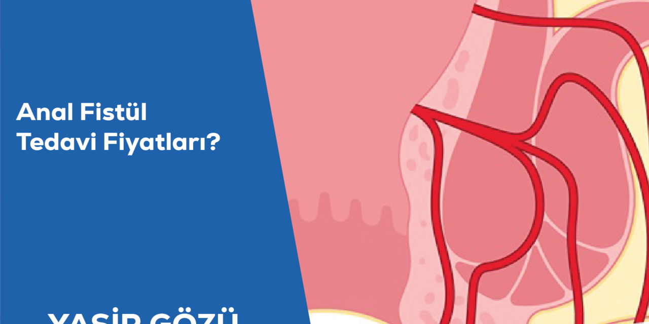 Anal Fistül Tedavi Fiyatları?