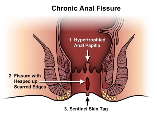 anal fissür