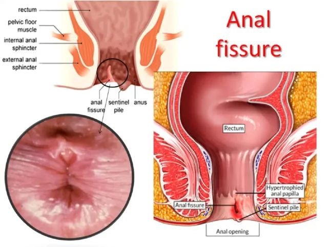 anal fissür