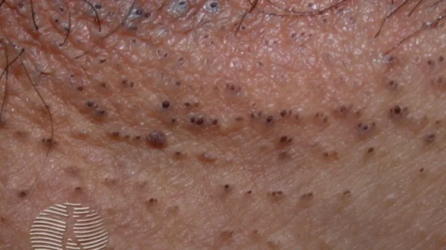 hidradenitis suppurativa