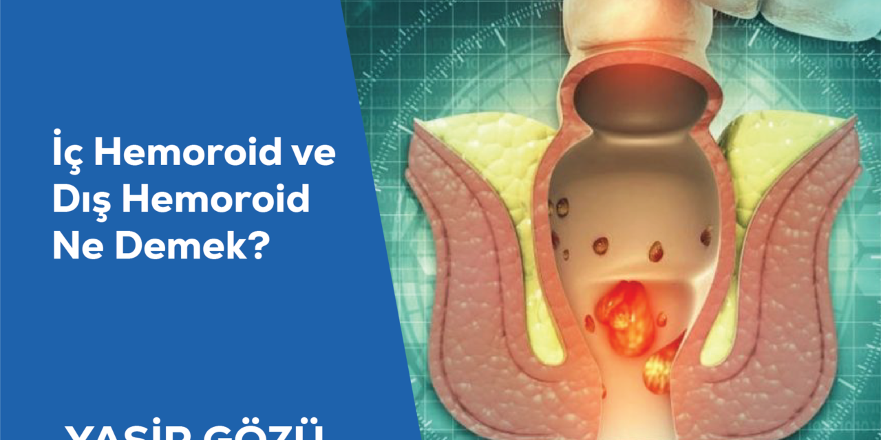 İç Hemoroid ve Dış Hemoroid Ne Demek?