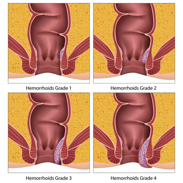 hemoroid