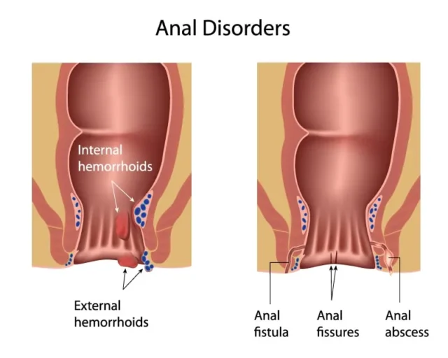anal fissür