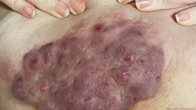 Hidradenitis suppurativa