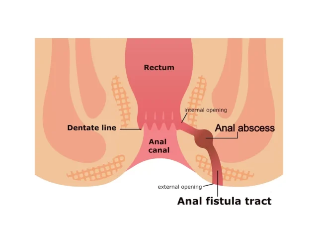 anal fistül