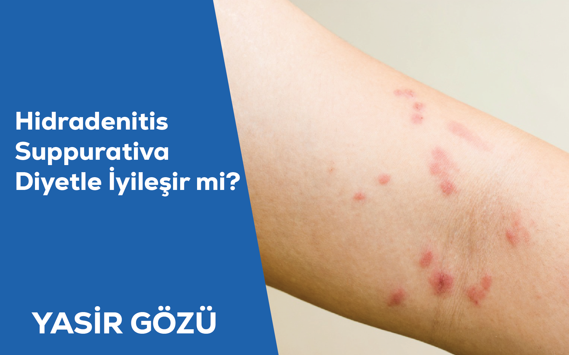 Hidradenitis Suppurativa Diyetle İyileşir mi?