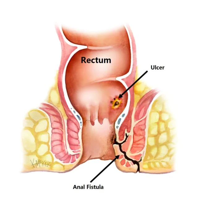 anal fistül