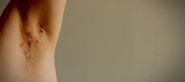 Hidradenitis Suppurativa