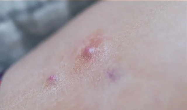 Hidradenitis suppurativa