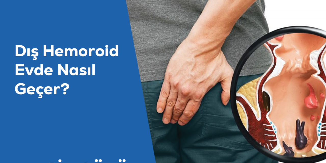 Dış Hemoroid Evde Nasıl Geçer?