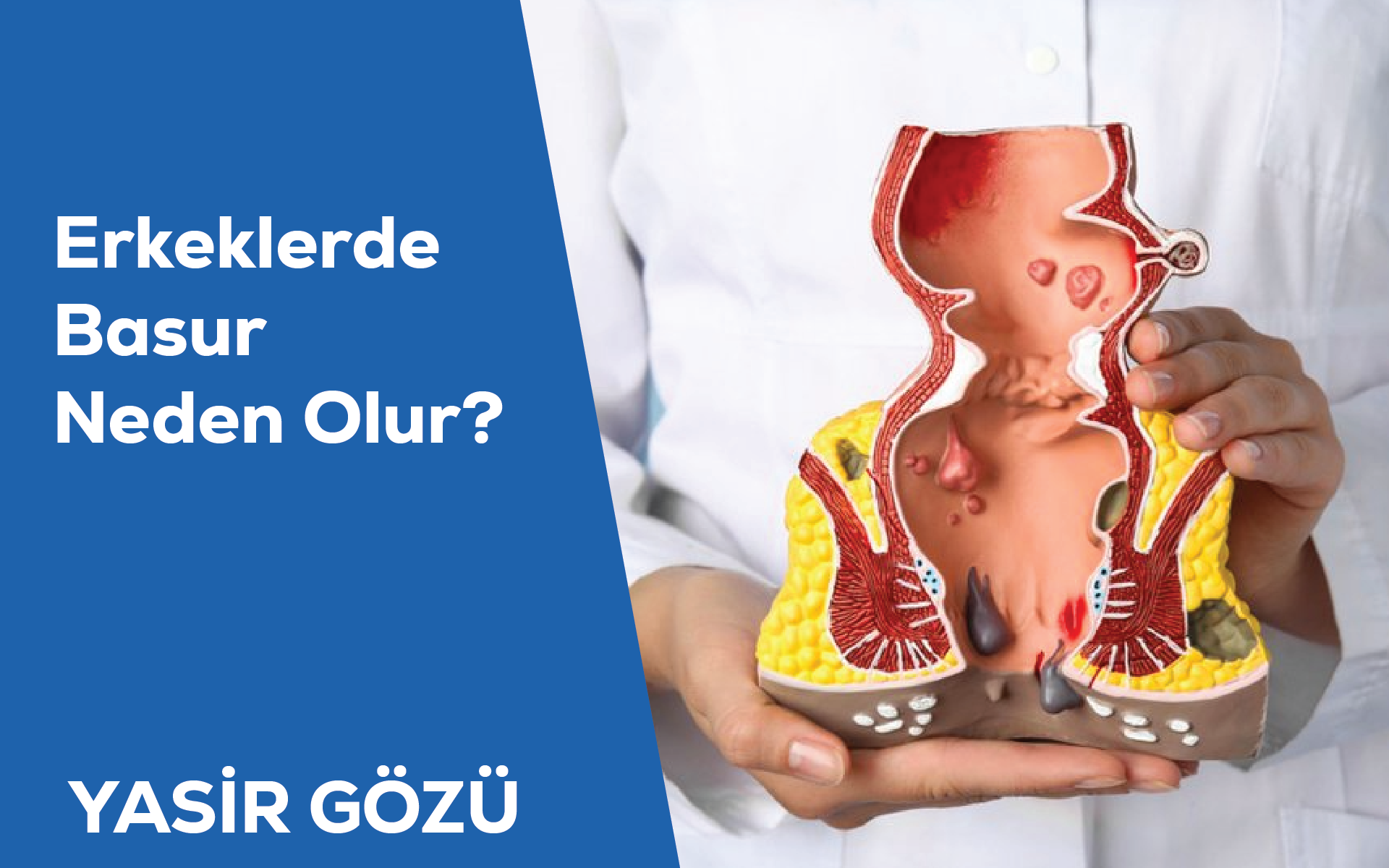 Erkeklerde Basur Neden Olur?
