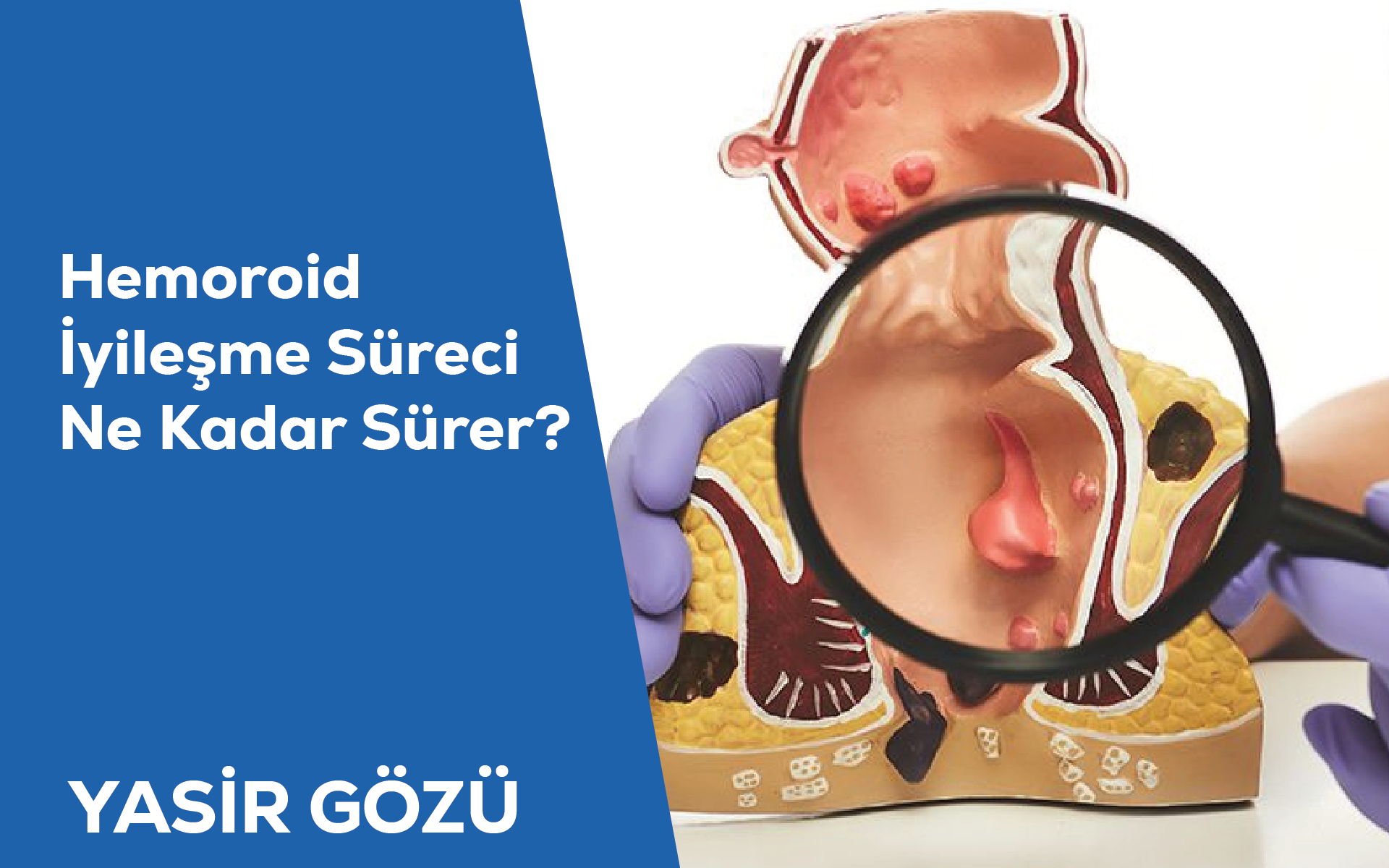Hemoroid İyileşme Süreci Ne Kadar Sürer?