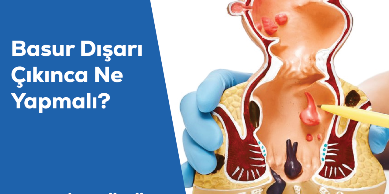 Basur Dışarı Çıkınca Ne Yapmalı?